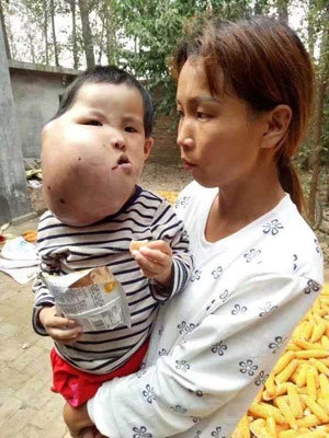 顔面を巨大な腫瘍に侵された3歳の女児(新浪新聞)