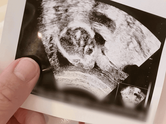 辻希美、妊娠中のエコー写真を公開するもネット上では厳しい声が続出
