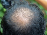 免疫細胞の異常が「脱毛」の真因だった（depositphotos.com）