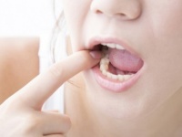 笑ったときのチラ見え、恥ずかしい!?　「銀歯」はコンプレックスだと思う女性は35％！