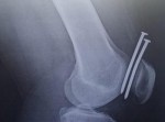 膝に釘を撃ち込んだが「２００万分の１の確率」で無事だった男