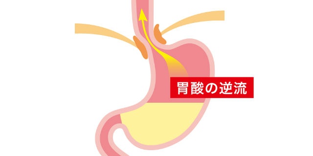 胃酸の逆流