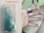 【注意】スマホケースで化学火傷の恐れ！　皮膚がただれる事例が多発