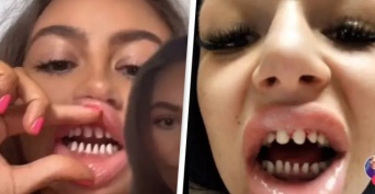 白く美しい歯を手に入れるため、一旦健康な歯を削り「サメの歯」にする施術に歯科医が警告