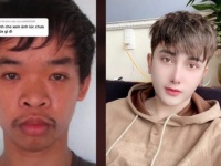 就活のために顔を大幅に改造した男性の整形ビフォア・アフター（ベトナム）