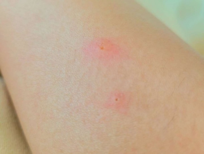 刺されてませんか?(画像はイメージ)