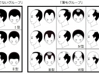“髪が薄い人は頭皮が硬い”ことが判明！『男性の毛髪と頭皮に関する研究』