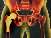 3Dプリンターは骨の再生医療の救世主？（depositphotos.com）