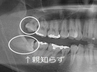 歯科医に聞く。親知らずを放っておくと口が開かなくなった！