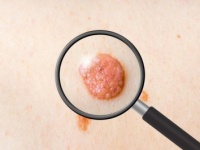 【医師監修】正しいニキビの治し方って？　ニキビの種類と原因