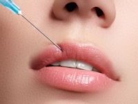 唇にヒアルロン酸を注射する「リップ注入」（shutterstock.com）