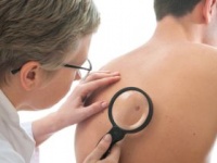 ほくろが多い人は皮膚がんのリスクが高い!?（shutterstock.com）