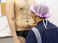 シックスパックをすぐにでも手に入れたい？タイで話題の人工シックスパック整形手術とは？