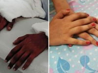 肌の色が違う男性からの両手移植手術を受けた女性、手の色が自身の色に変化（インド）