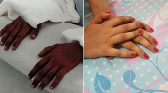 肌の色が違う男性からの両手移植手術を受けた女性、手の色が自身の色に変化（インド）