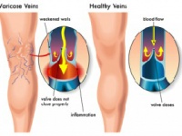 下肢静脈瘤のある足（左）と健康な足（depositphotos.com）