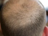 新たに承認された皮膚炎治療薬に思わぬ発毛効果。全頭性脱毛症の少女の髪の毛が劇的に生える（米研究）