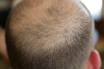 新たに承認された皮膚炎治療薬に思わぬ発毛効果。全頭性脱毛症の少女の髪の毛が劇的に生える（米研究）