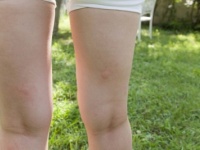 跡、つきすぎじゃない？　男性がガッカリした女性の「生足」4選
