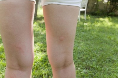 跡、つきすぎじゃない？　男性がガッカリした女性の「生足」4選