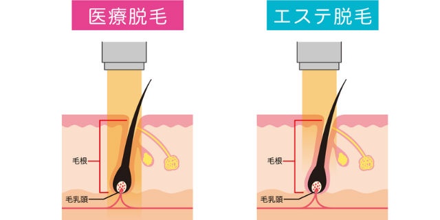 エステサロンとクリニックの脱毛の違い