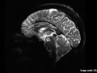 鮮明！最強のMRI装置の驚異の解像度で脳内がくっきり