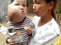 顔面を巨大な腫瘍に侵された3歳の女児（新浪新聞）
