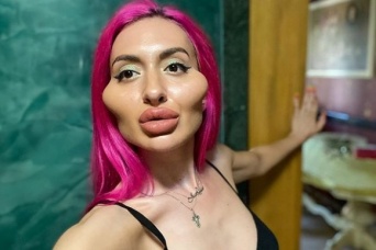 「後悔はしていない、自分の理想はこの形」頬骨を強調するための整形を繰り返す女性（ウクライナ）