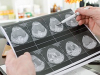 MRI検査で「認知症」の診断と治療が向上（shutterstock.com）