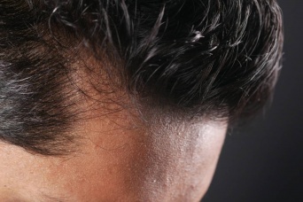 髪の毛の増殖と成長を促すシグナル伝達分子が発見される