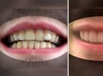 歯の矯正高すぎ…⇒　自分で矯正具作るか！