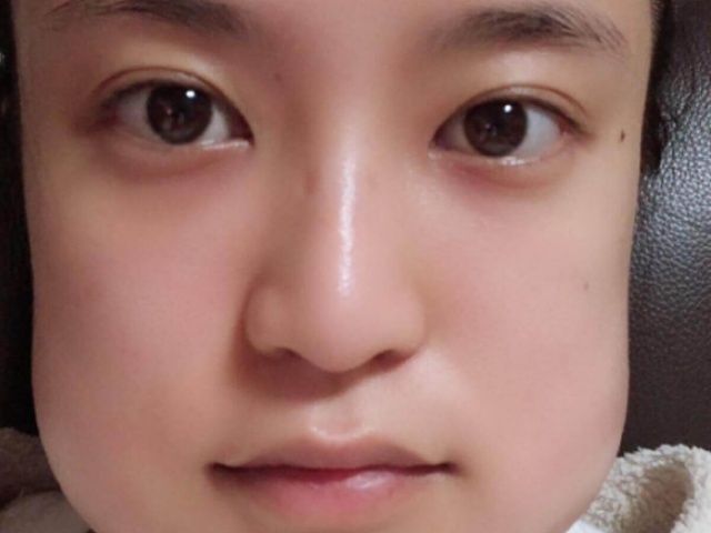 小島瑠璃子 抜歯直後の顔面変形にネット騒然 食パンマンみたい 1ページ目 デイリーニュースオンライン