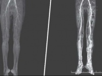 脚に灼熱の痛みを感じた女性、中世に流行した「麦角菌病」と診断される