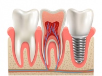 歯の神経の治療とは？（depositphotos.com）