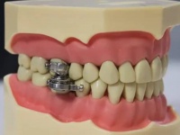 流動食しか摂取できない究極のダイエット装置が開発される