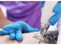 タトゥーを除去するレーザー手術（「Getty Images」より）