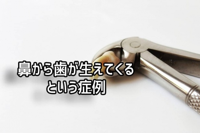 本当にあった奇妙な症例。鼻の中で歯が成長