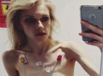 【若干閲覧注意】体重３５キロ以下…　彼女はなぜ拒食症になったのか？