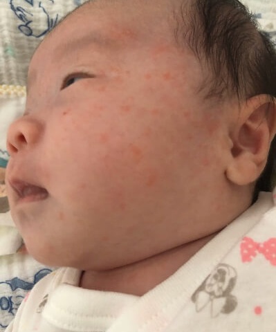 キンタロー 娘の湿疹を心配するも違うところで批判殺到 1ページ目 デイリーニュースオンライン