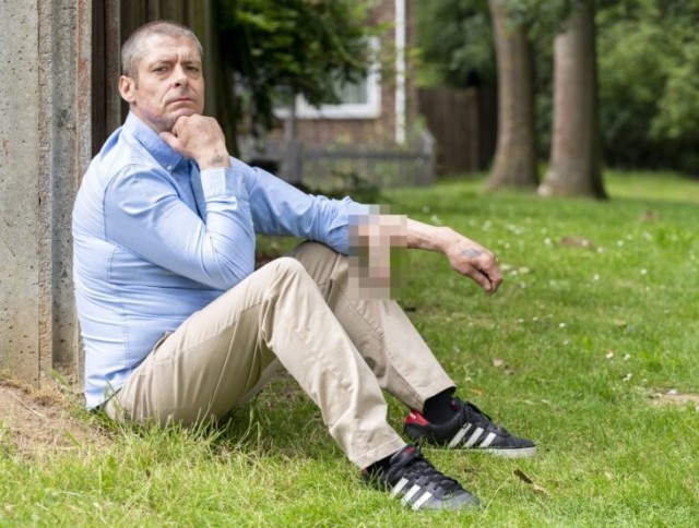 大切なイチモツを失った男性、腕に人工イチモツを生やして4年、移植手術を待ち続ける(イギリス)