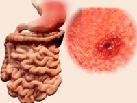 胃がんの最大の原因はピロリ菌（shutterstock.com）