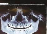 顔面に激痛！　レントゲンに写っていた眼球の下の「異物」とは？