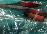 【中国】夫婦喧嘩の末になぜか“ピンセット”を飲み込んだ男…