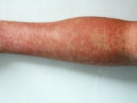 39℃以上の高熱が出て顔や体に発疹（shutterstock.com）