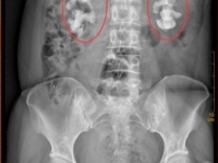 女性の腎臓をびっしりと埋め尽くす結石 (出典：中新網)
