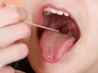 「くさい玉」って何？　耳鼻咽喉科医に聞く「膿栓」のギモン