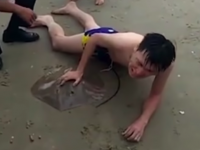 そんなにヤバイのか！男性が海で息子スティックをエイに刺されるという悲劇。救急隊が出動(中国)