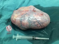 湖北省大悟県に住む12歳女児から、重さ約6キロの巨大奇形腫が摘出された