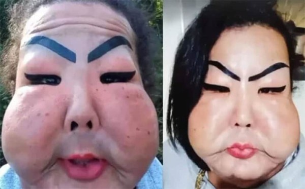 闇クリニックで工業用シリコンを顔面に注入された女性、顔が風船のように膨れ上がる