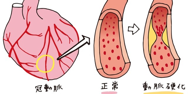 動脈硬化の仕組み